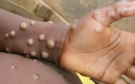 Dünya Sağlık Örgütü (DSÖ) M çiçeği aşısını onayladı