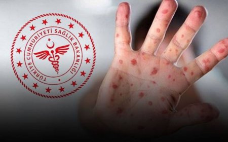 İstanbul'da görüldüğü iddia edilmişti: Sağlık Bakanlığı'ndan Maymun Çiçeği açıklaması