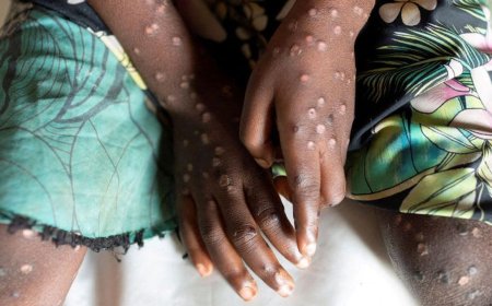 'Maymun çiçeği' iki ülkeye daha bulaştı