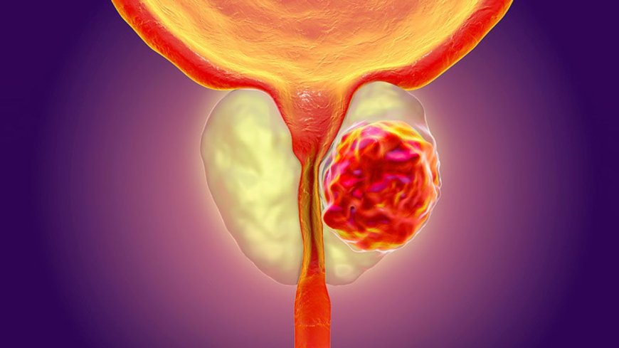 Erken teşhis edilen prostat kanseri neredeyse yüzde 100 tedavi edilebiliyor