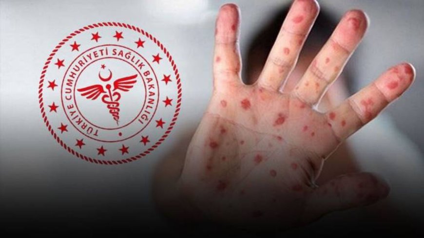 İstanbul'da görüldüğü iddia edilmişti: Sağlık Bakanlığı'ndan Maymun Çiçeği açıklaması