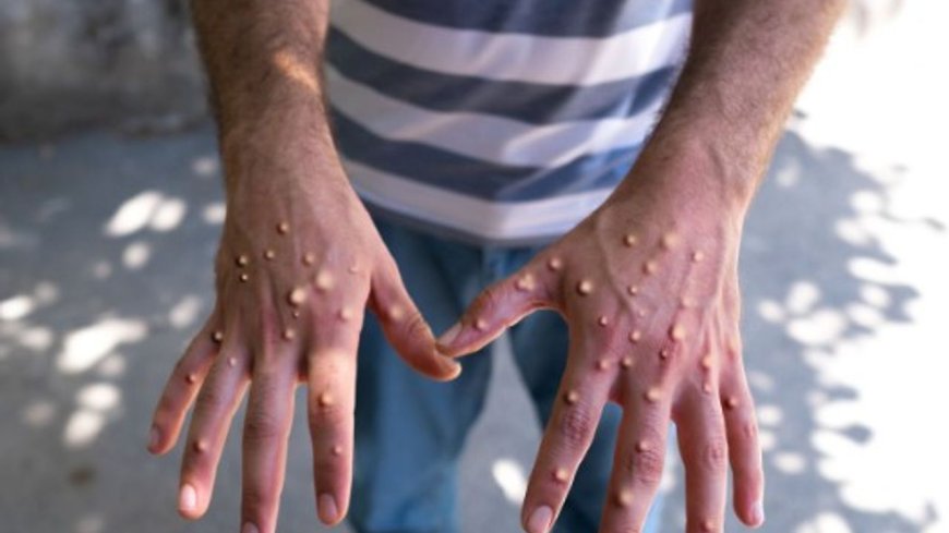 Maymun çiçeği virüsü bir ülkeye daha sıçradı!